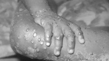 Ülkede maymun çiçeği paniği! İlk kez görüldü